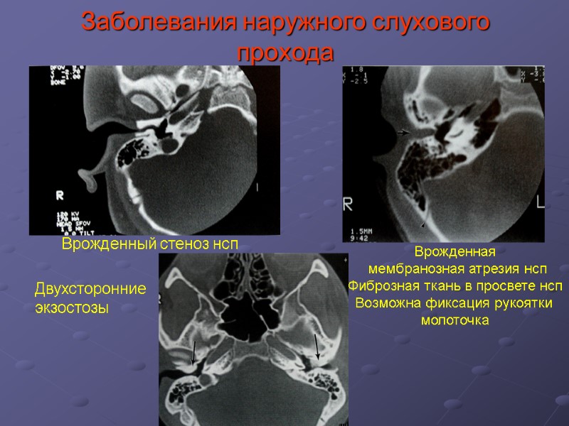 Заболевания наружного слухового прохода Врожденный стеноз нсп Врожденная  мембранозная атрезия нсп Фиброзная ткань